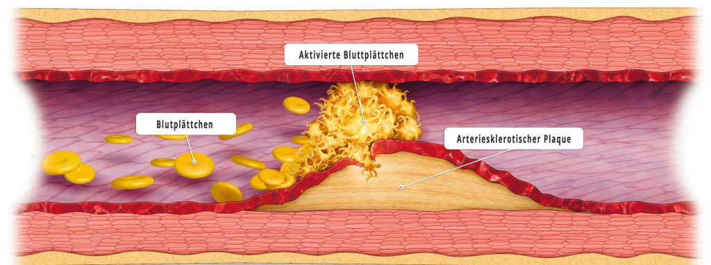 So entsteht Arteriosklerose. (Quelle: Bayer research)