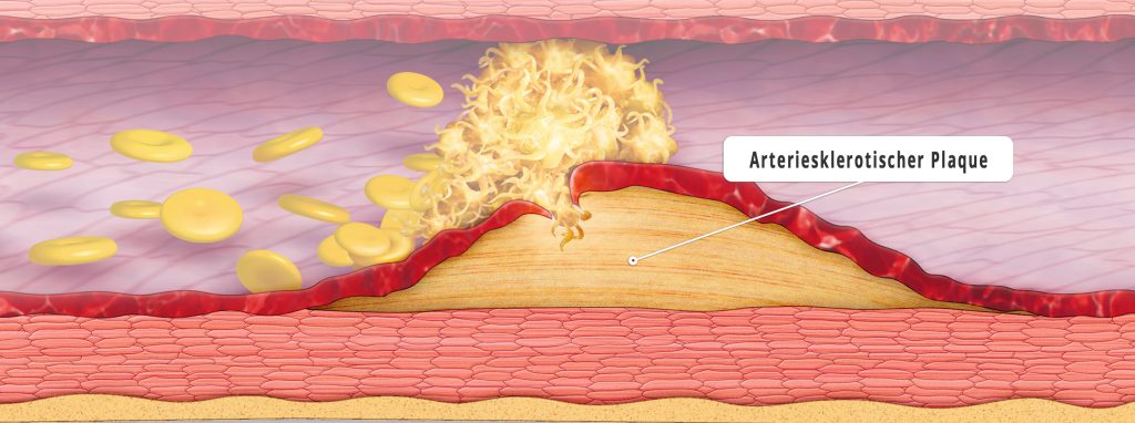 Blutfette und weiße Blutkörperchen lagern sich in die entzündete Gefäßwand ein und bewirken eine Verdickung (Plaque). (Quelle: Bayer research)