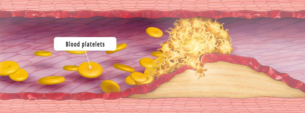 If the thin layer lining the blood vessel (endothelium) is torn at one point, the thrombocytes come into direct contact with tissue factors. This leads to an activation of the thrombocytes, which change their shape, form a clot (thrombus) and thus block the vessel. (Credit: Bayer research)