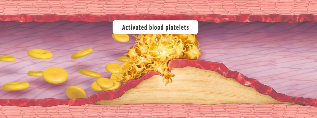 That is how arteriosclerosis develops. (Credit: Bayer research)